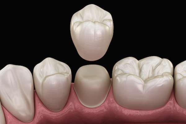 What To Ask Your General Dentist When Preparing for a Crown from North County Cosmetic and Implant Dentistry in Vista, CA