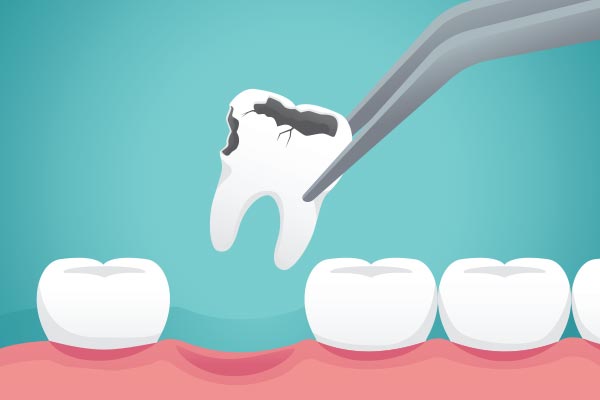 Ask a General Dentist: What Happens to Your Tooth After Extraction from North County Cosmetic and Implant Dentistry in Vista, CA