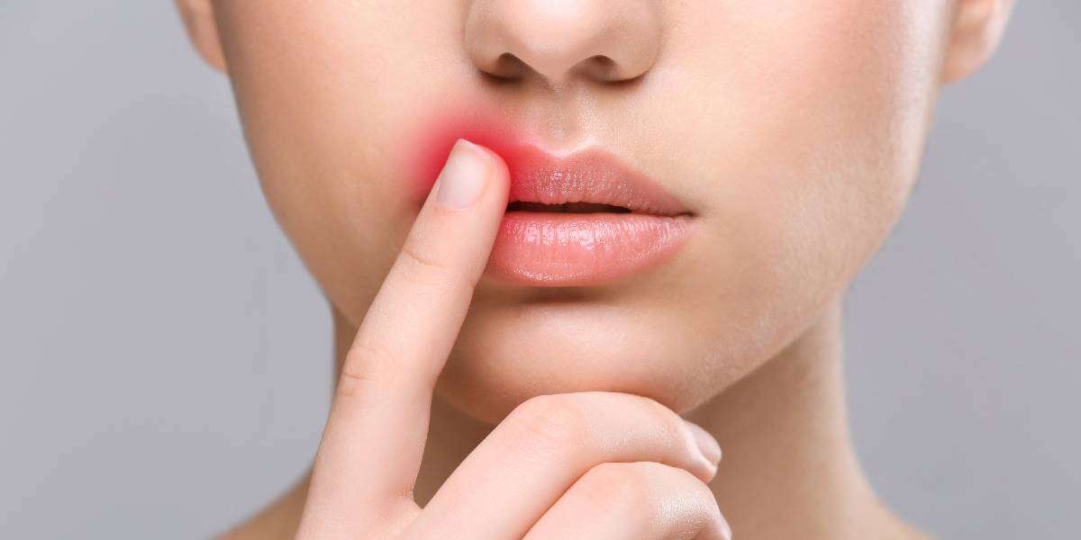 A Better Way To Treat Summer Cold Sores: Laser Dentistry