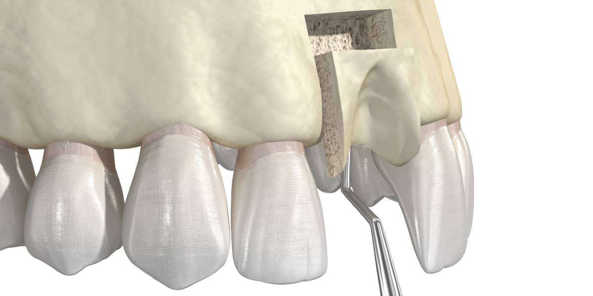 Dental Bone Grafts: Transforming Smiles With North County Cosmetic And Implant Dentistry