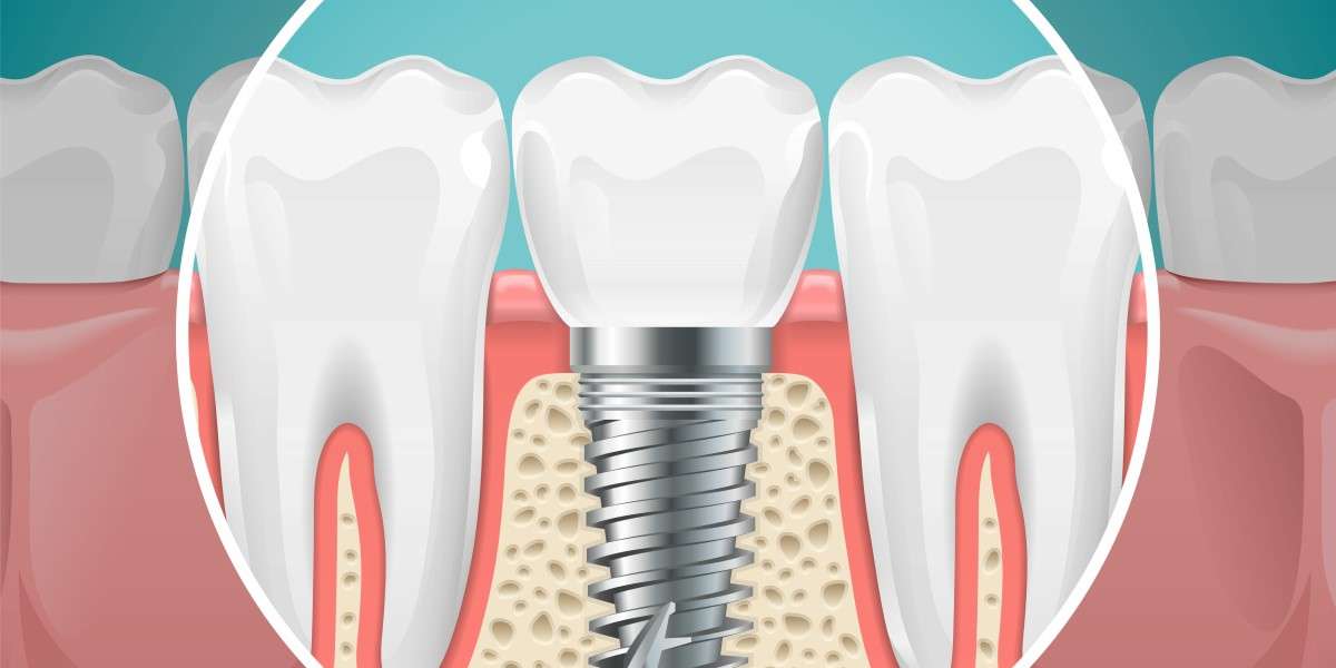The Benefits of Replacing Missing Teeth with Dental Implants from North County Cosmetic and Implant Dentistry in Vista, CA