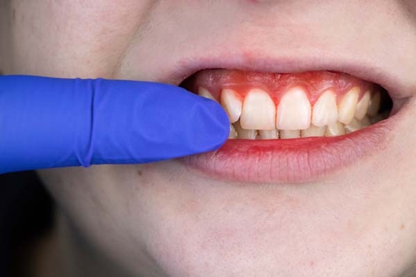 How Is Plaque Involved With Gum Disease?