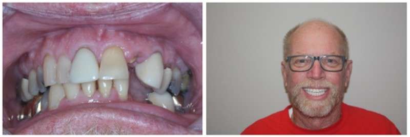 Before And After Dental Implants: Meet Ray