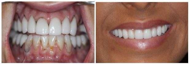 Before And After Dental Implants: Meet Sara