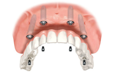 Can You Get a Temporary Tooth During the Dental Implant Process? - Jagare  Dental