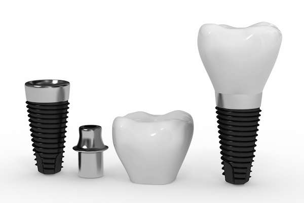 What Are the Parts of Dental Implants from North County Cosmetic and Implant Dentistry in Vista, CA