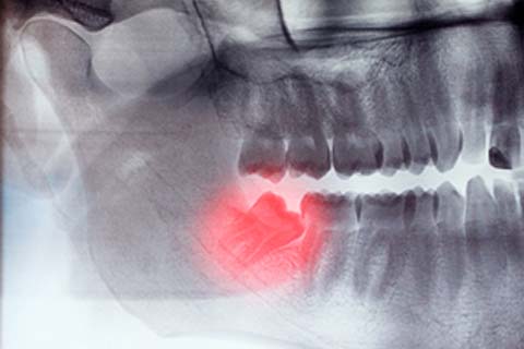 Extract Or Keep: Weighing Your Wisdom Teeth Options